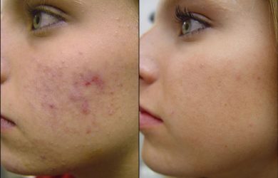6 Most effective Natural Home Remedies to Get rid of Acne pimples