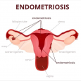 What is Endometriosis and What are the Complications Related to it?