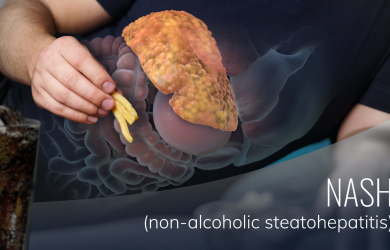 Hepatitis Caused by Nonalcoholic Steatosis (NASH)