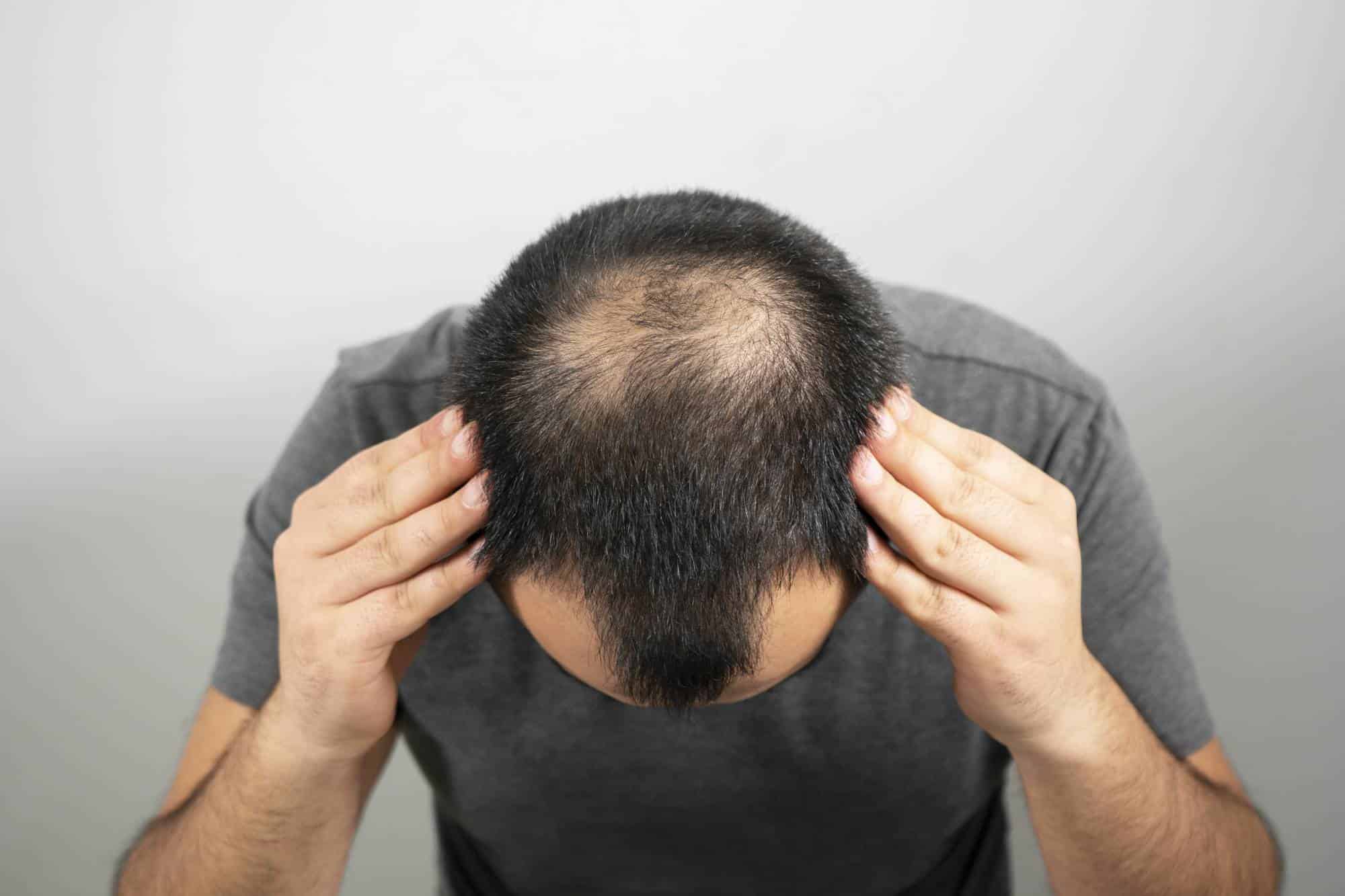 How much Does a Hair Transplant Cost in Navi Mumbai?