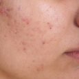 Clear and Unbiased Facts about Acne Removal