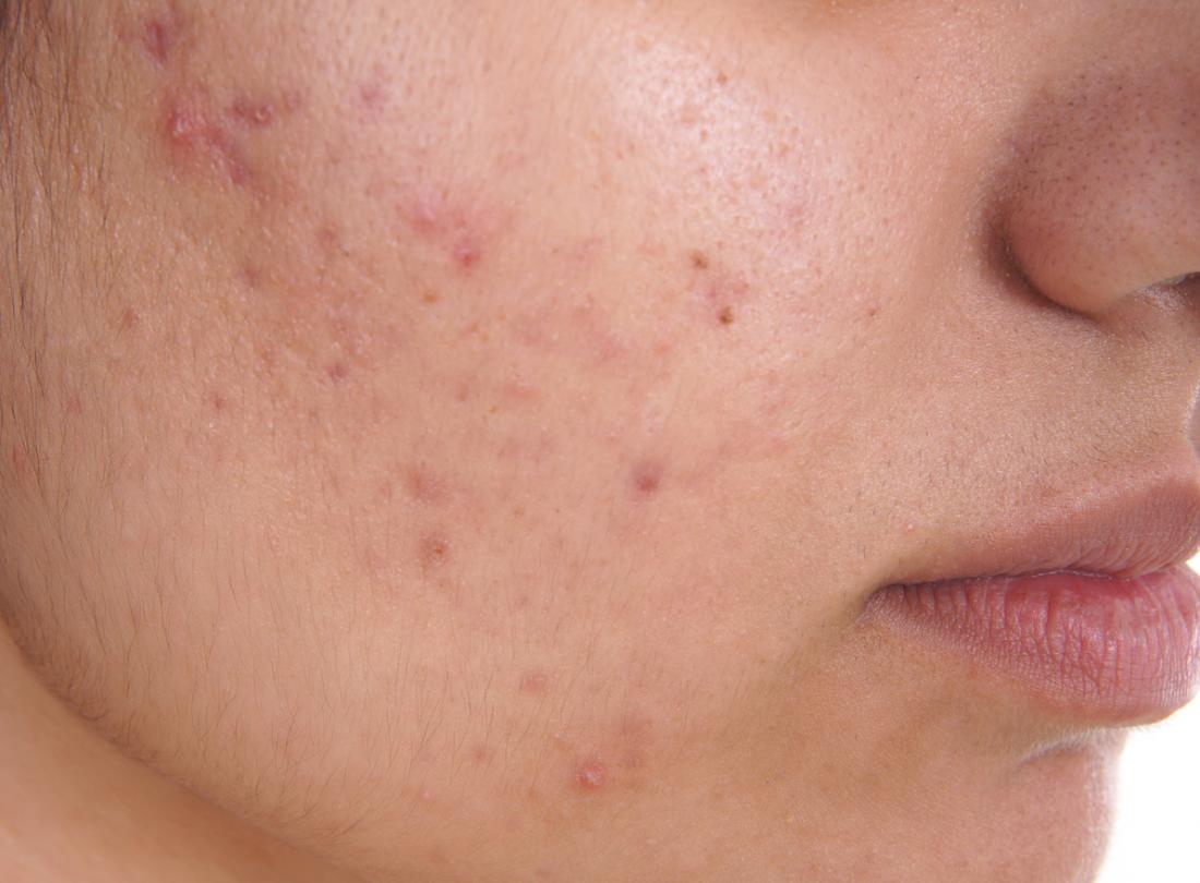 Clear and Unbiased Facts about Acne Removal