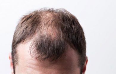 The Best Hair Transplant in Hyderabad: Learn about it