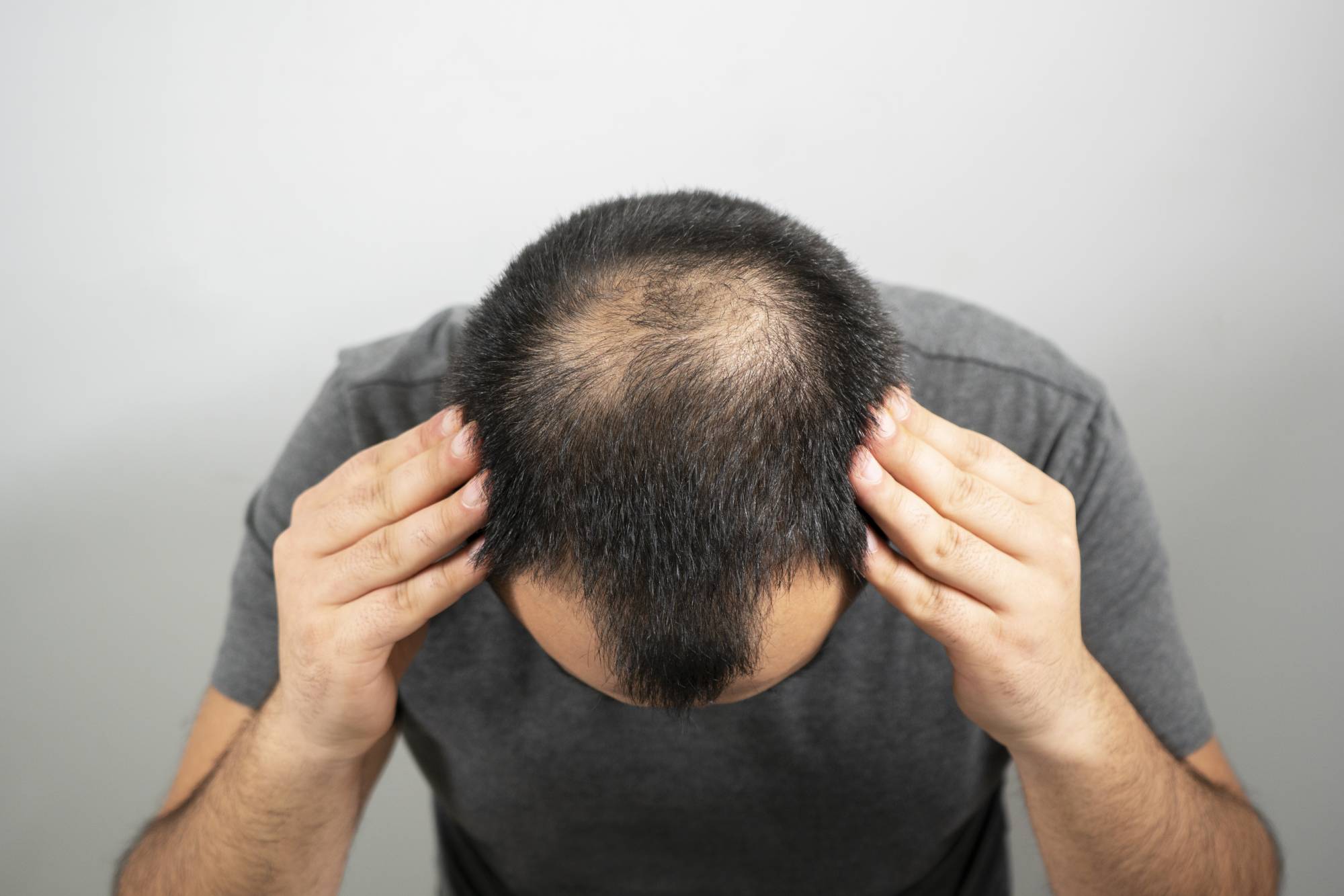 Stage 7 Baldness: Understand the Journey of Hair Transplant